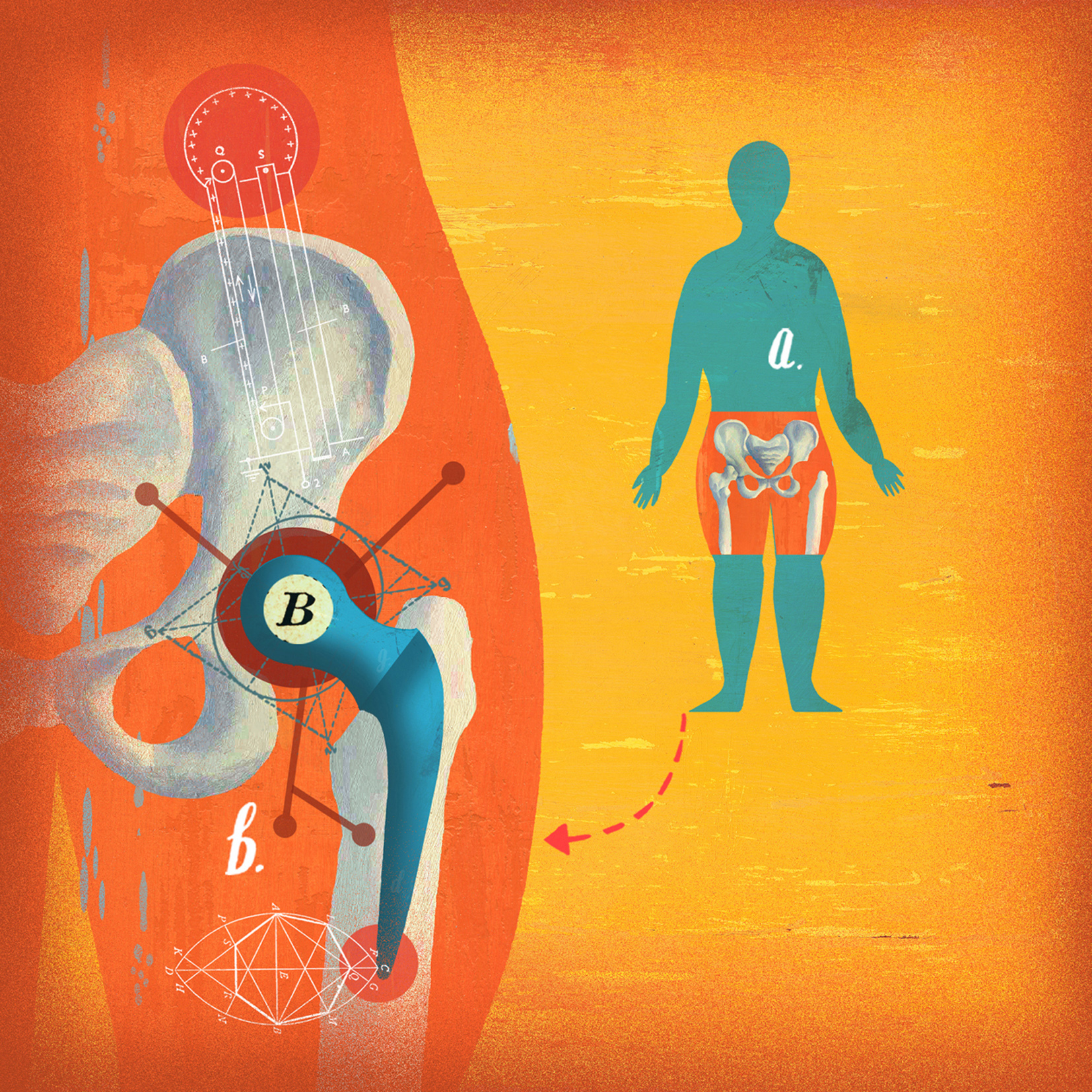 Hip Replacement