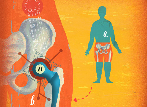Hip Replacement